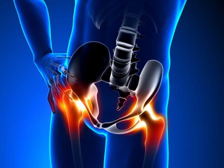 Does Physical Therapy Really Help Hip Bursitis?